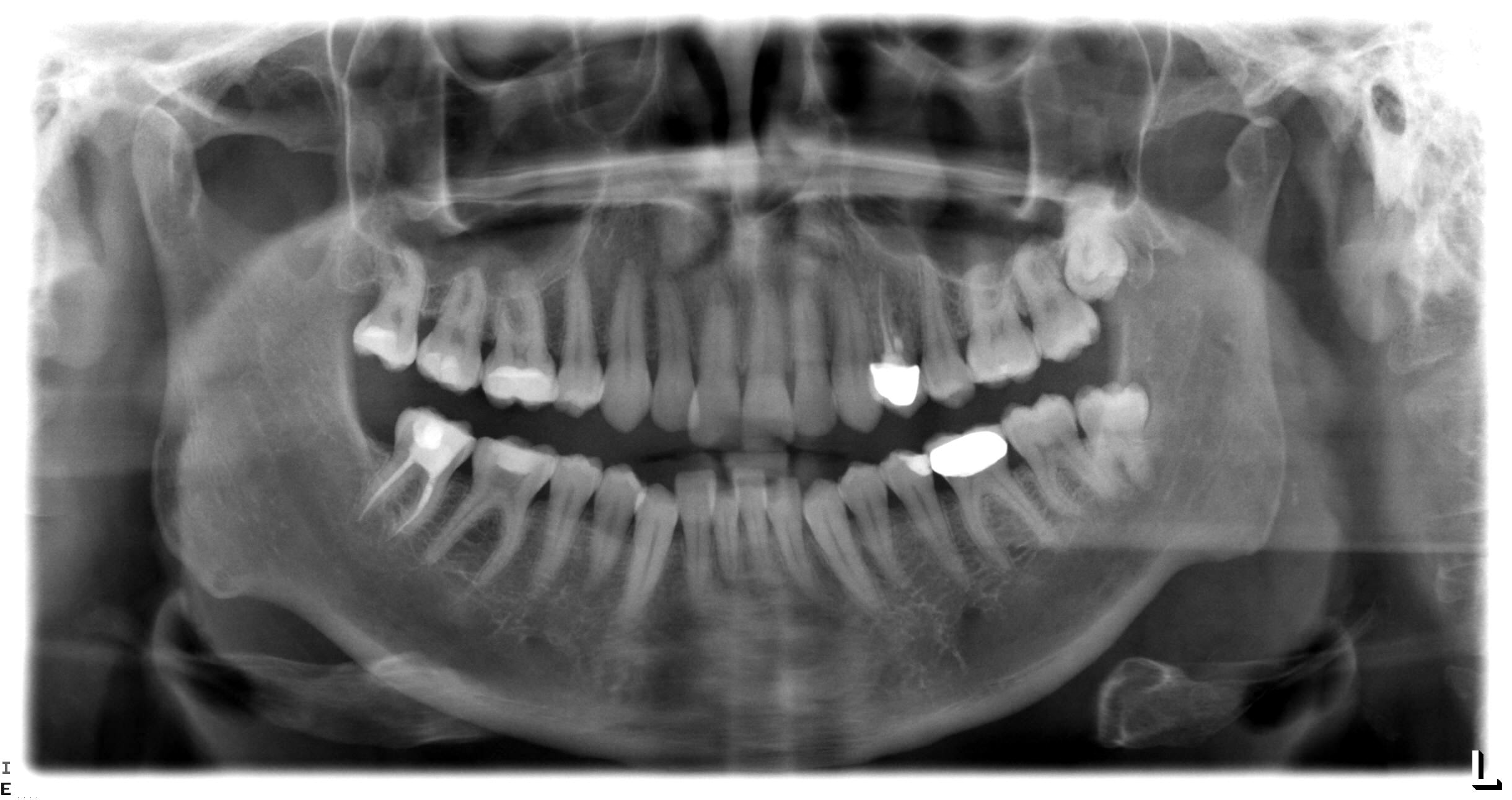 Example of Good Panoral x-ray